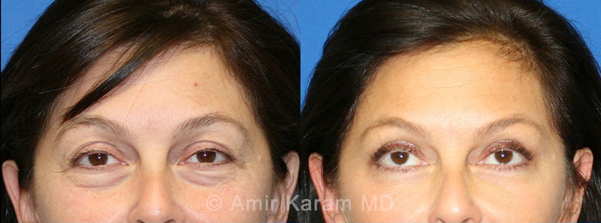 Eye Rejuvenation Before & After Gallery - Patient 71698695 - Image 2