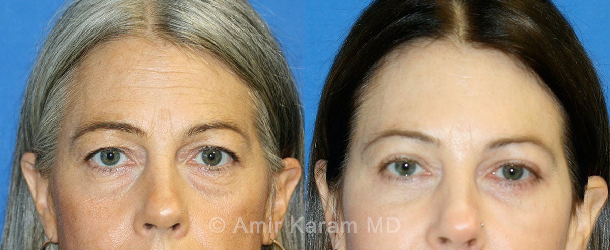 Eye Rejuvenation Before & After Gallery - Patient 71700133 - Image 1