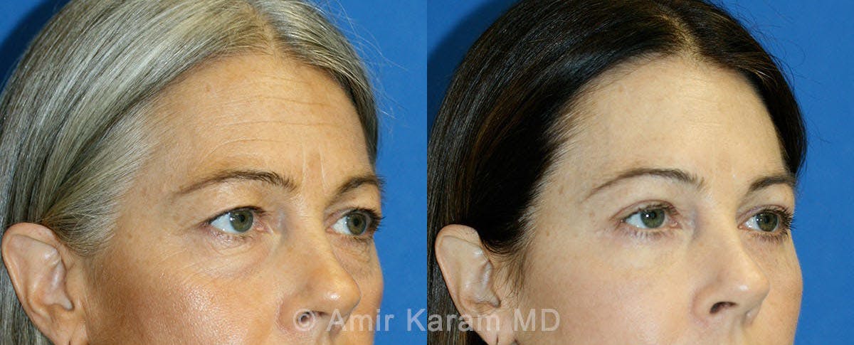 Eye Rejuvenation Before & After Gallery - Patient 71700133 - Image 2
