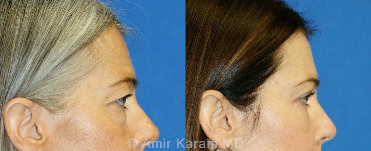 Eye Rejuvenation Before & After Gallery - Patient 71700133 - Image 3