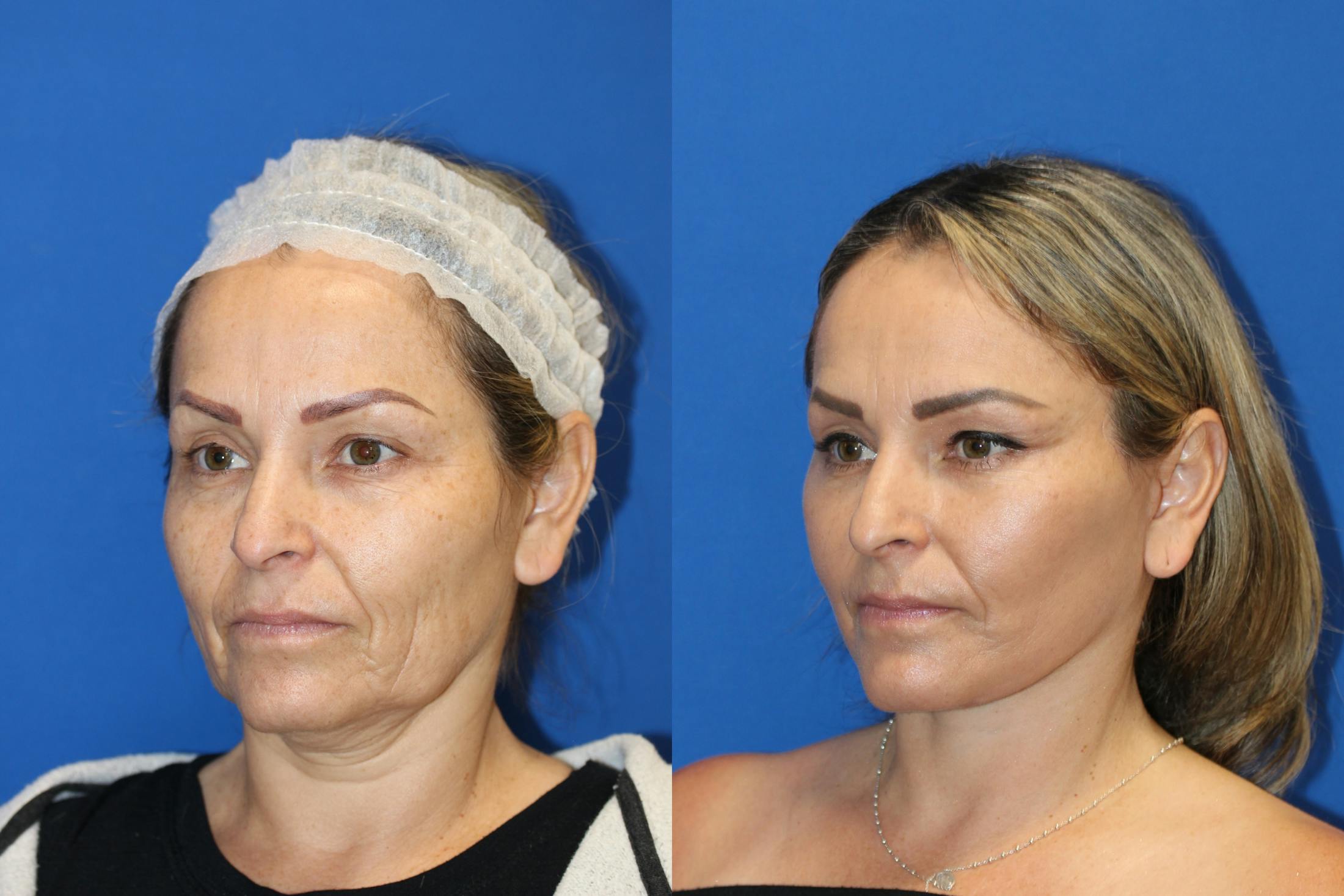 Neck Lift Before & After Gallery - Patient 85195665 - Image 4