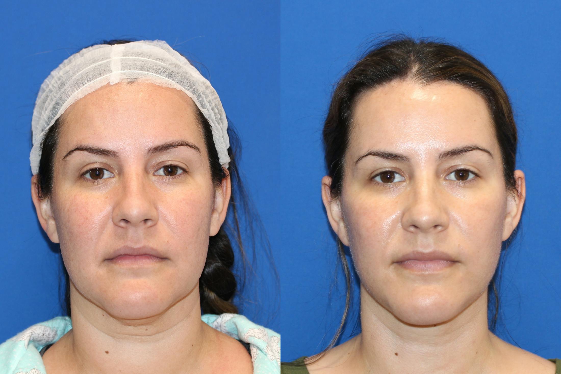 Vertical Restore® / Facial Rejuvenation Before & After Gallery - Patient 76119232 - Image 1