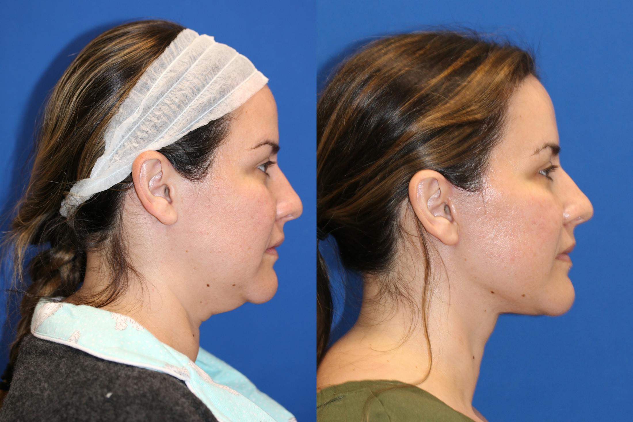 Vertical Restore® / Facial Rejuvenation Before & After Gallery - Patient 76119232 - Image 2