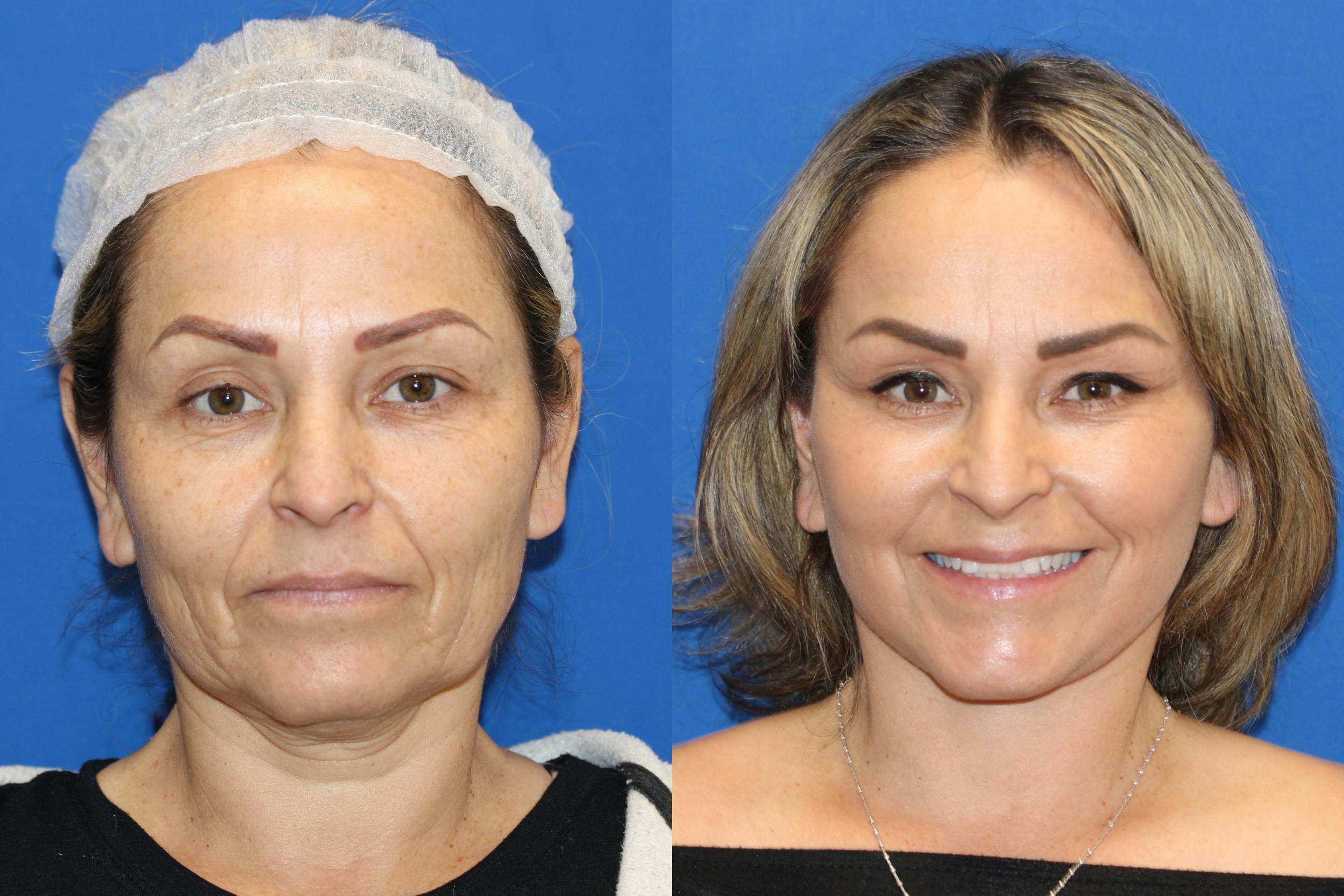 Vertical Restore® / Facial Rejuvenation Gallery - Patient 76142759 - Image 1