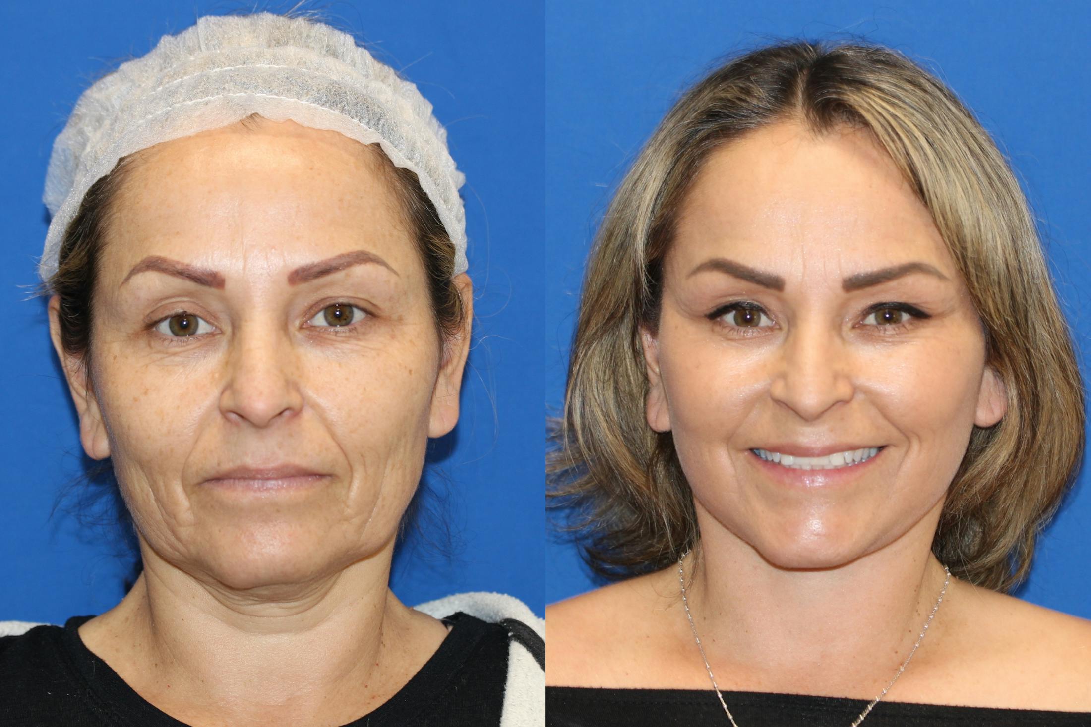 Vertical Restore® / Facial Rejuvenation Before & After Gallery - Patient 76142759 - Image 1