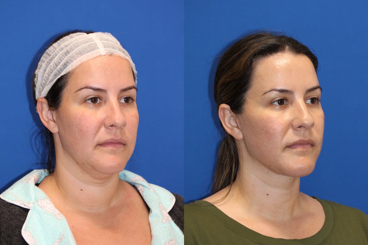 Vertical Restore® / Facial Rejuvenation Before & After Gallery - Patient 76119232 - Image 3