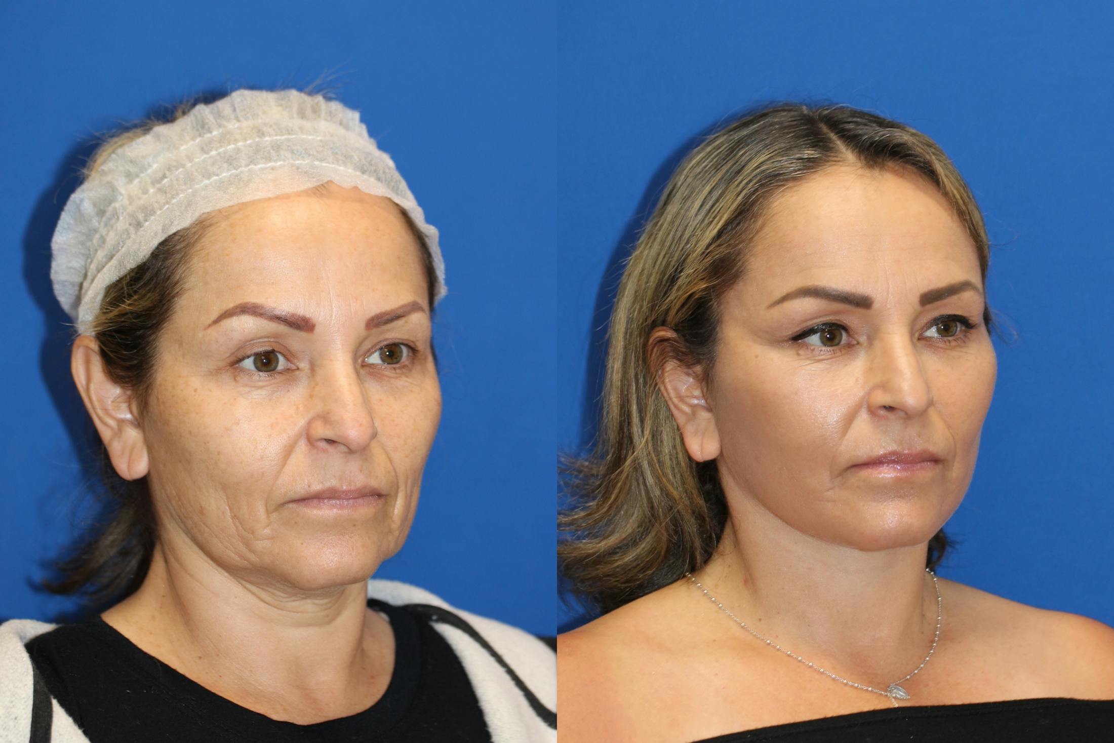 Vertical Restore® / Facial Rejuvenation Before & After Gallery - Patient 76142759 - Image 3