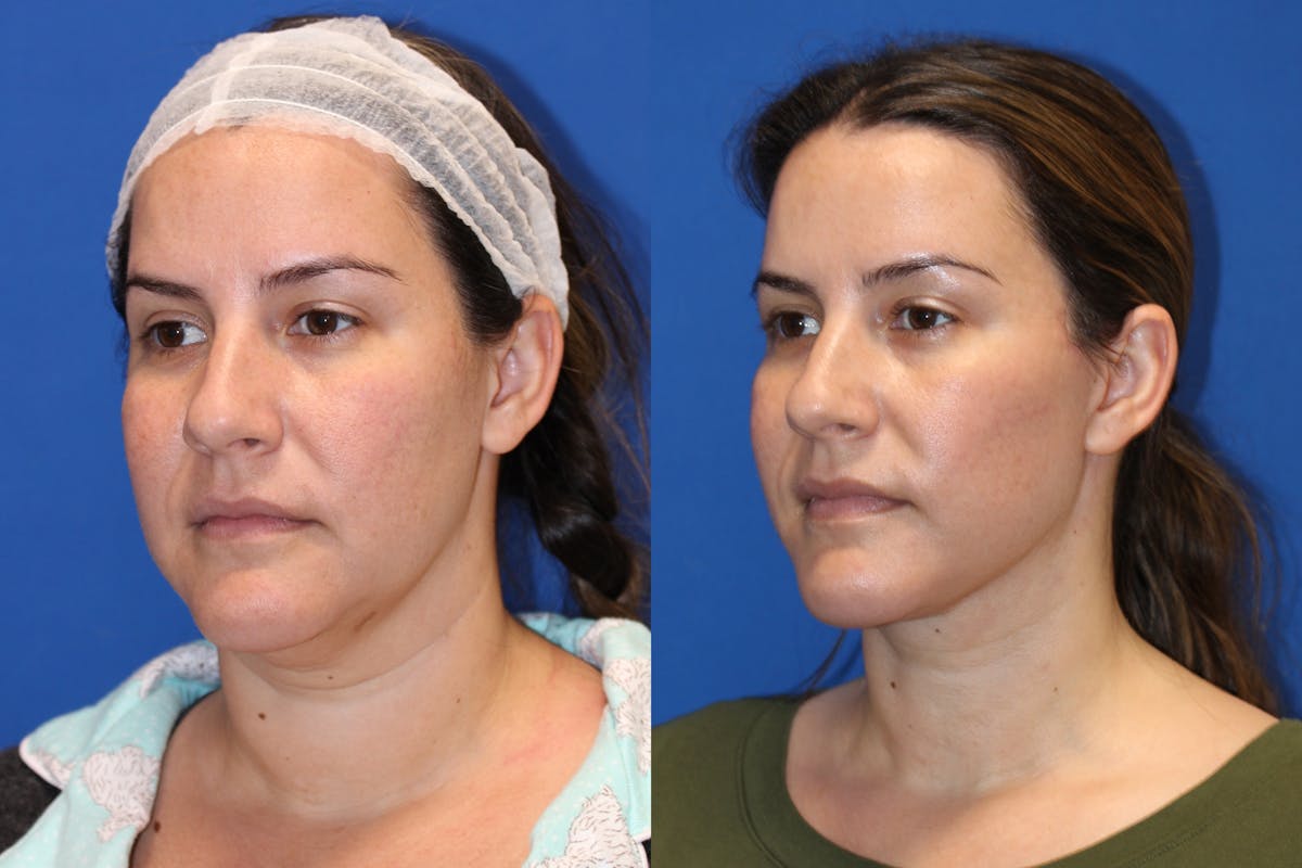 Vertical Restore® / Facial Rejuvenation Before & After Gallery - Patient 76119232 - Image 4