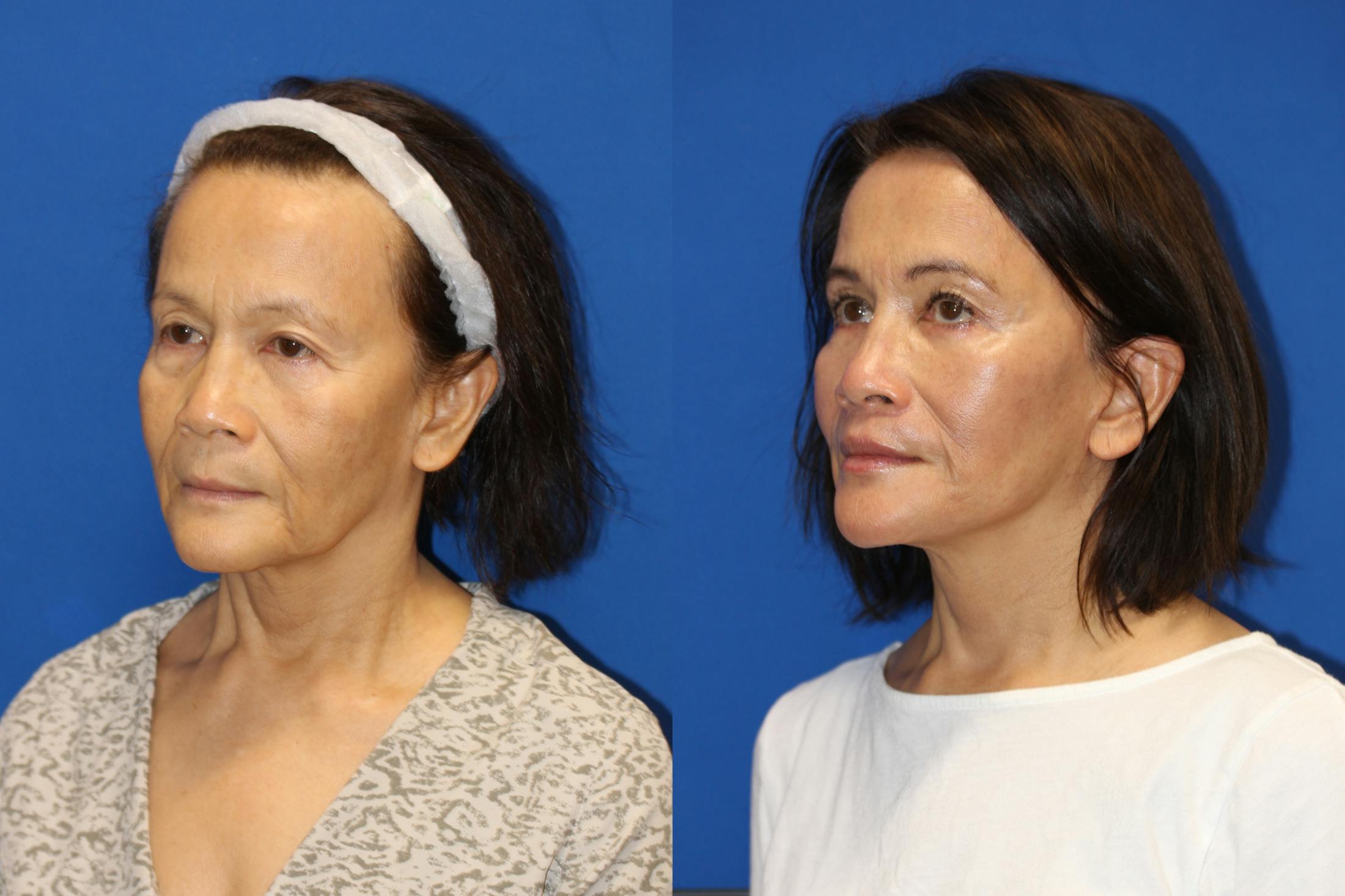 Vertical Restore® / Facial Rejuvenation Before & After Gallery - Patient 76129743 - Image 5