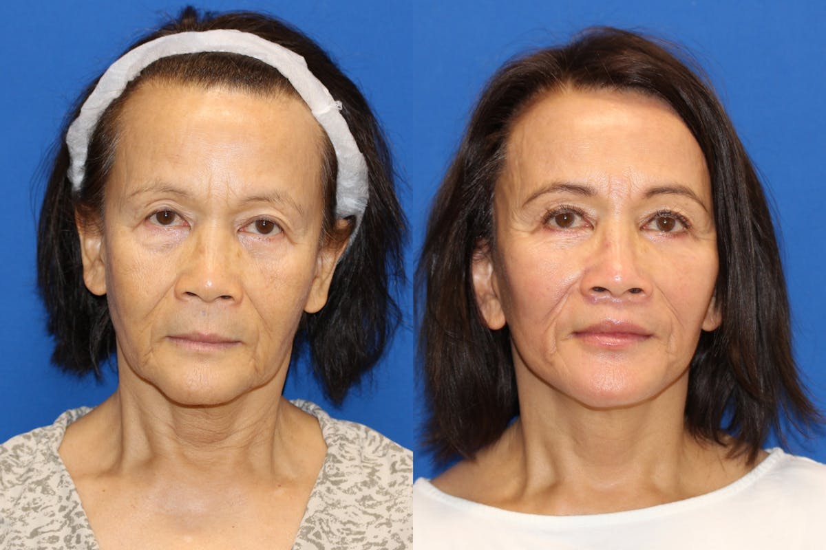 Vertical Restore® / Facial Rejuvenation Before & After Gallery - Patient 76129743 - Image 1