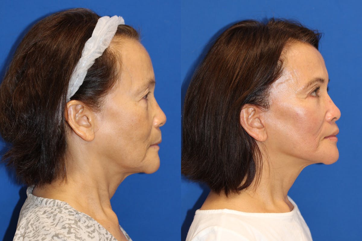 Vertical Restore® / Facial Rejuvenation Before & After Gallery - Patient 76129743 - Image 2