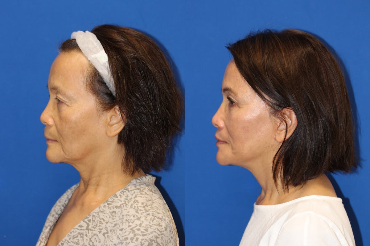 Vertical Restore® / Facial Rejuvenation Before & After Gallery - Patient 76129743 - Image 3