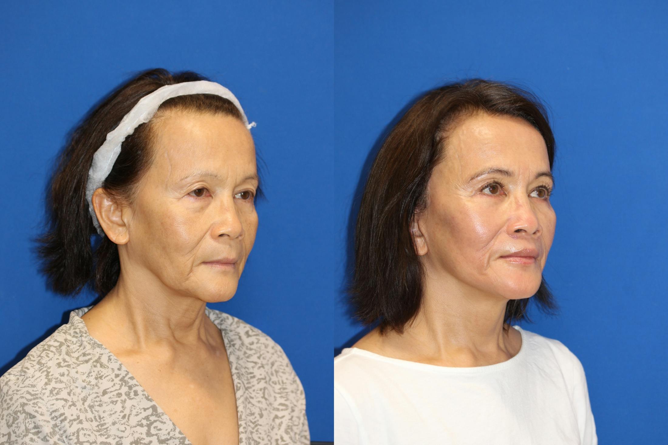 Vertical Restore® / Facial Rejuvenation Before & After Gallery - Patient 76129743 - Image 4