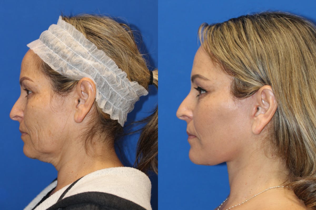 Neck Lift Before & After Gallery - Patient 85195665 - Image 3