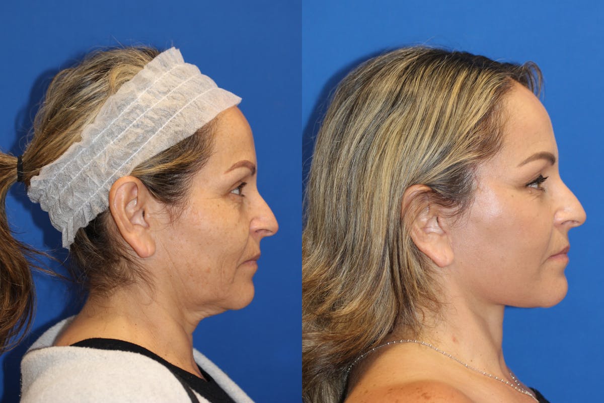 Neck Lift Before & After Gallery - Patient 85195665 - Image 1