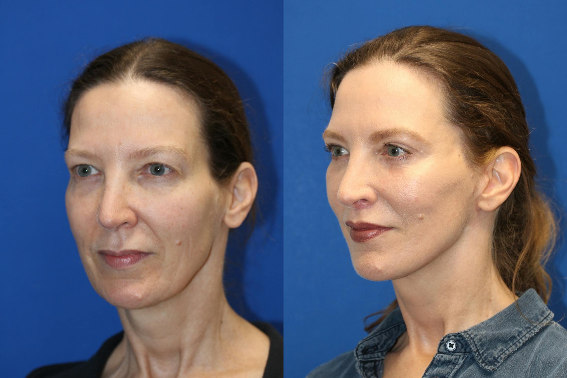 Vertical Restore® / Facial Rejuvenation Before & After Gallery - Patient 76142751 - Image 4