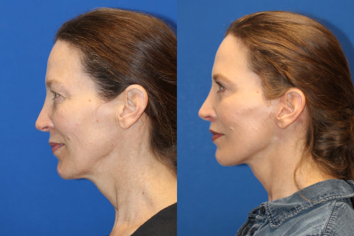Vertical Restore® / Facial Rejuvenation Before & After Gallery - Patient 76142751 - Image 3