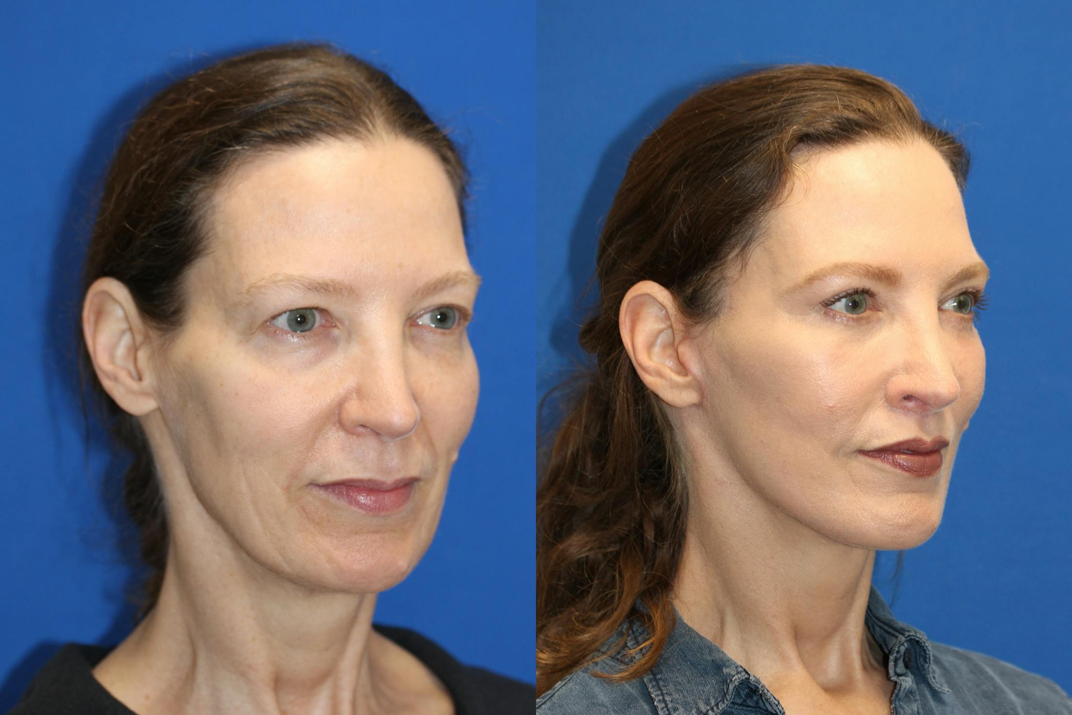 Vertical Restore® / Facial Rejuvenation Before & After Gallery - Patient 76142751 - Image 1