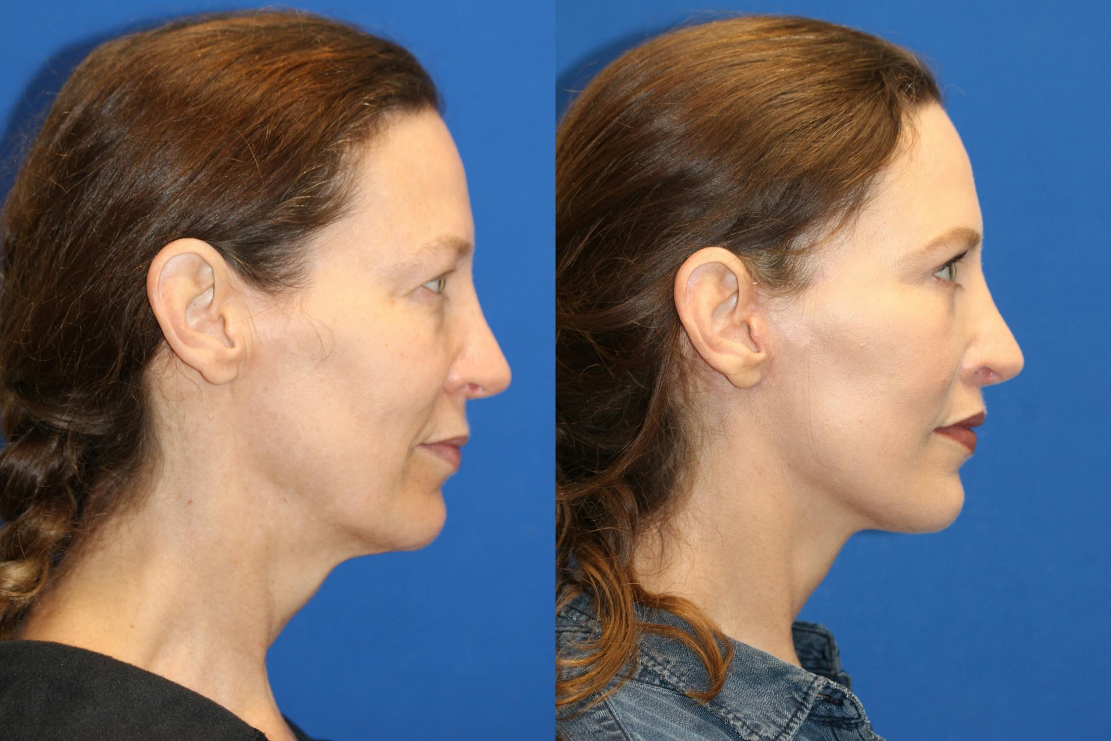 Fat Transfer Before & After Gallery - Patient 89289576 - Image 4