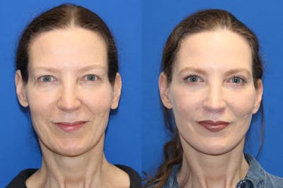 Fat Transfer Before & After Gallery - Patient 89289576 - Image 1