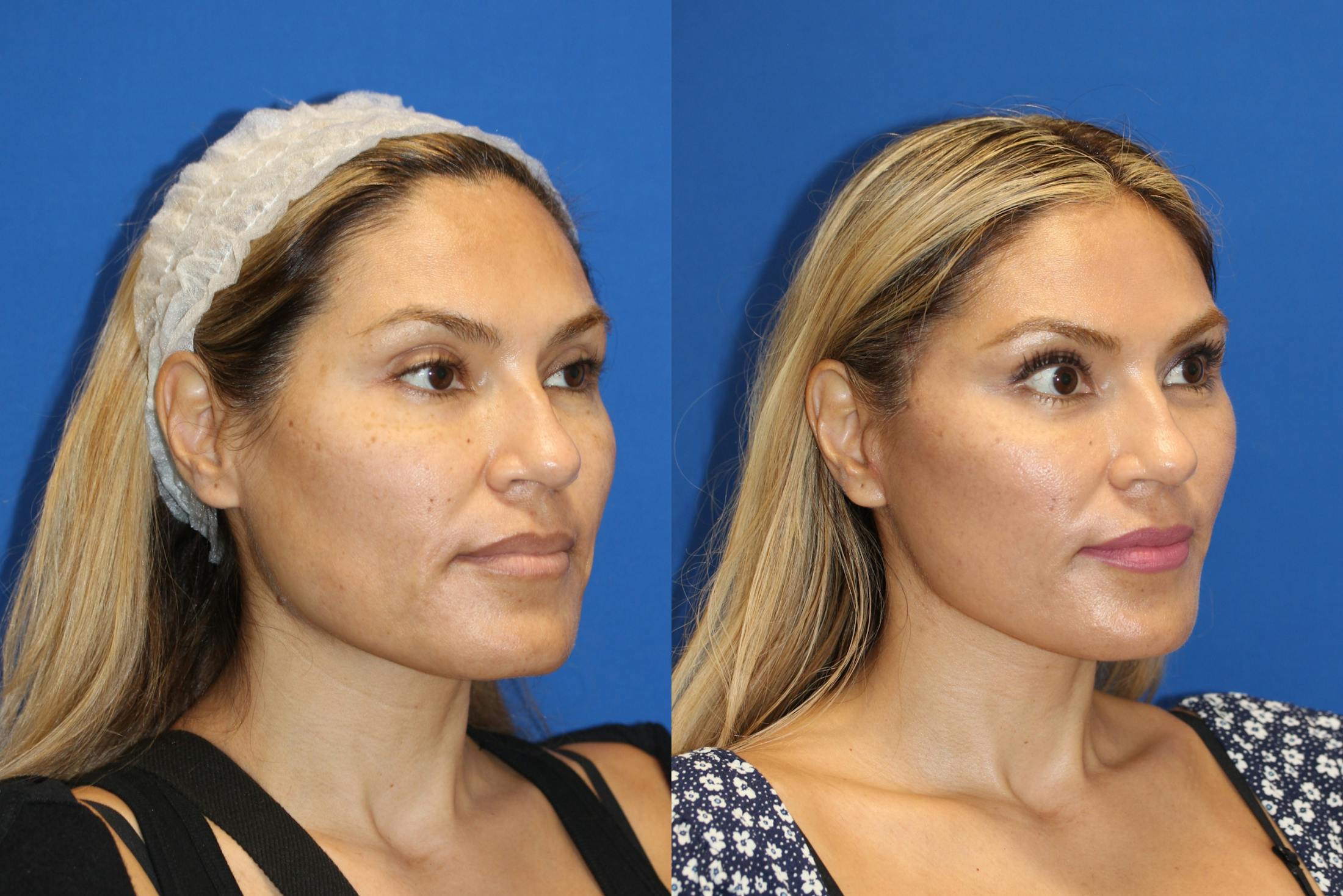 Vertical Restore® / Facial Rejuvenation Before & After Gallery - Patient 76142739 - Image 5