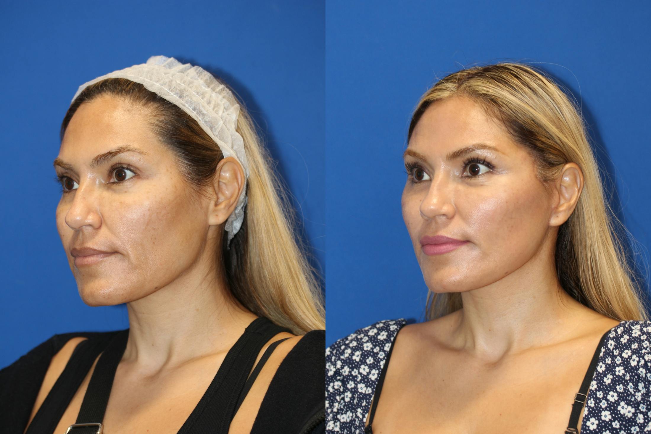 Vertical Restore® / Facial Rejuvenation Before & After Gallery - Patient 76142739 - Image 4
