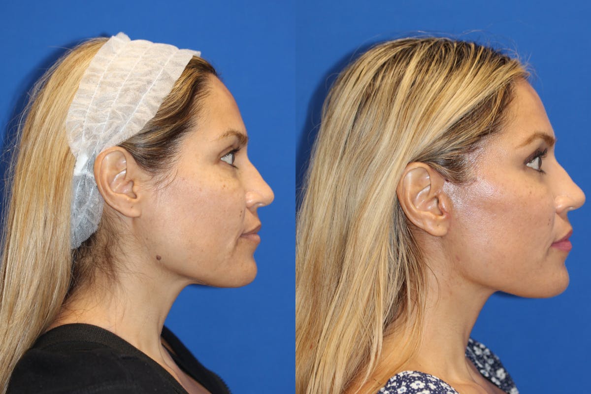 Vertical Restore® / Facial Rejuvenation Before & After Gallery - Patient 76142739 - Image 2