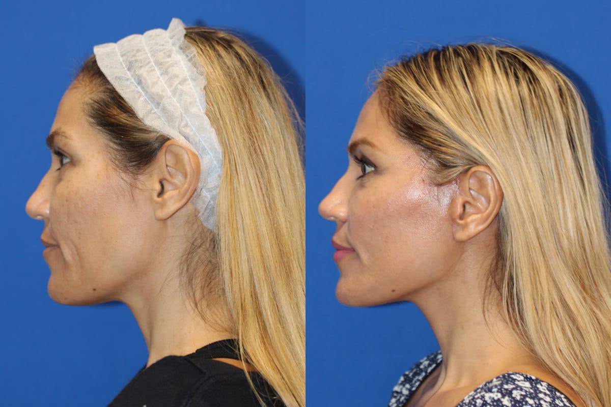 Fat Transfer Before & After Gallery - Patient 87435085 - Image 3