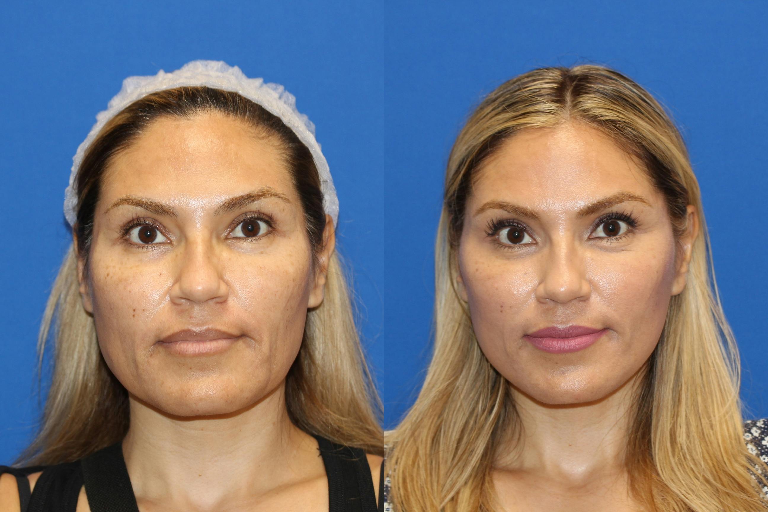 Patient 76142717 Vertical Restore® / Facial Rejuvenation Before