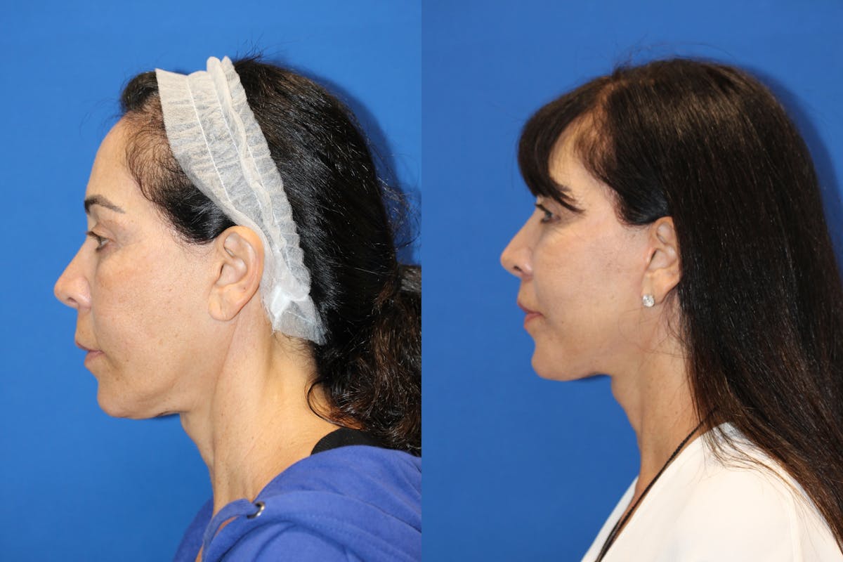 Vertical Restore® / Facial Rejuvenation Before & After Gallery - Patient 76142731 - Image 3
