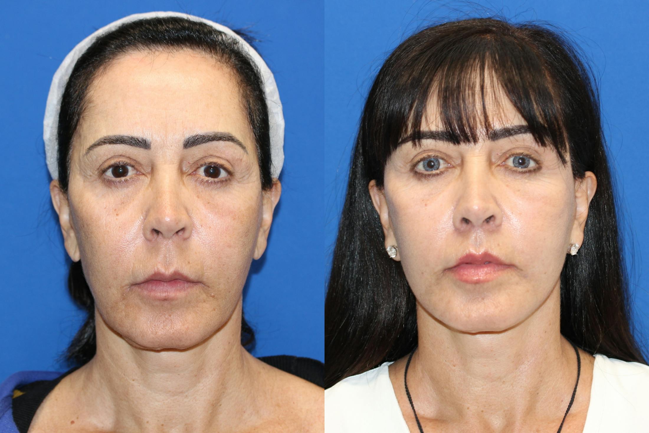 Vertical Restore® / Facial Rejuvenation Before & After Gallery - Patient 76142731 - Image 1