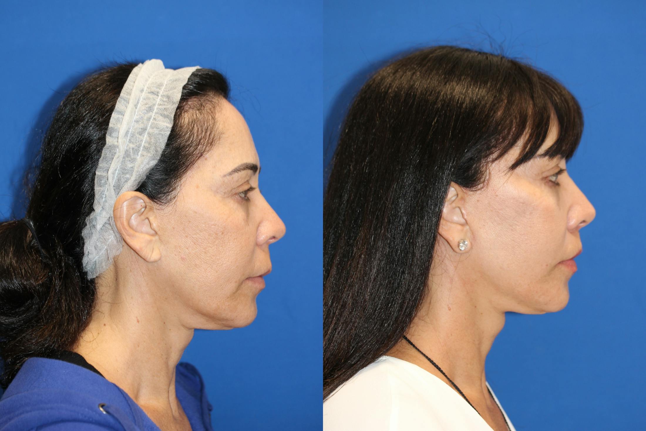 Lip Lift Before & After Gallery - Patient 83244939 - Image 2