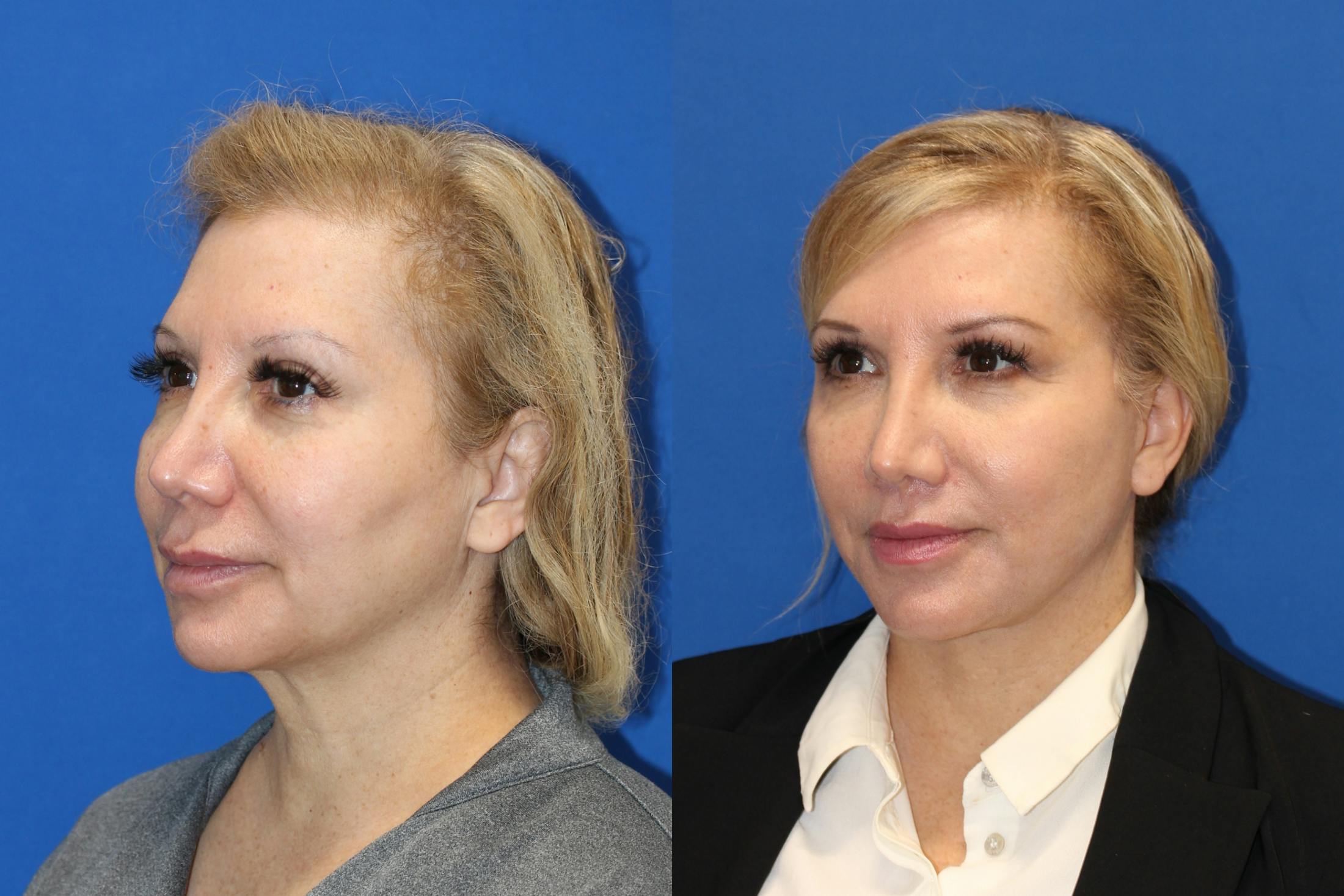 Vertical Restore® / Facial Rejuvenation Before & After Gallery - Patient 76142730 - Image 5