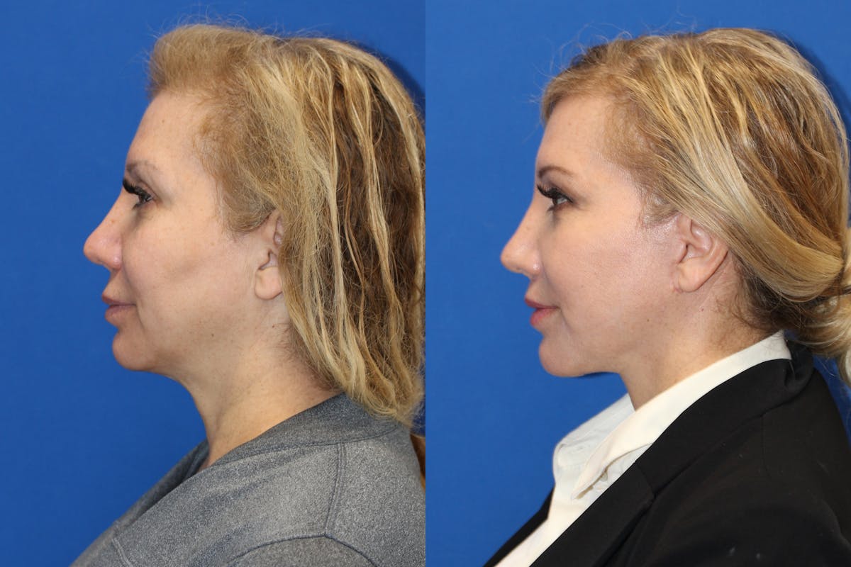 Vertical Restore® / Facial Rejuvenation Before & After Gallery - Patient 76142730 - Image 4