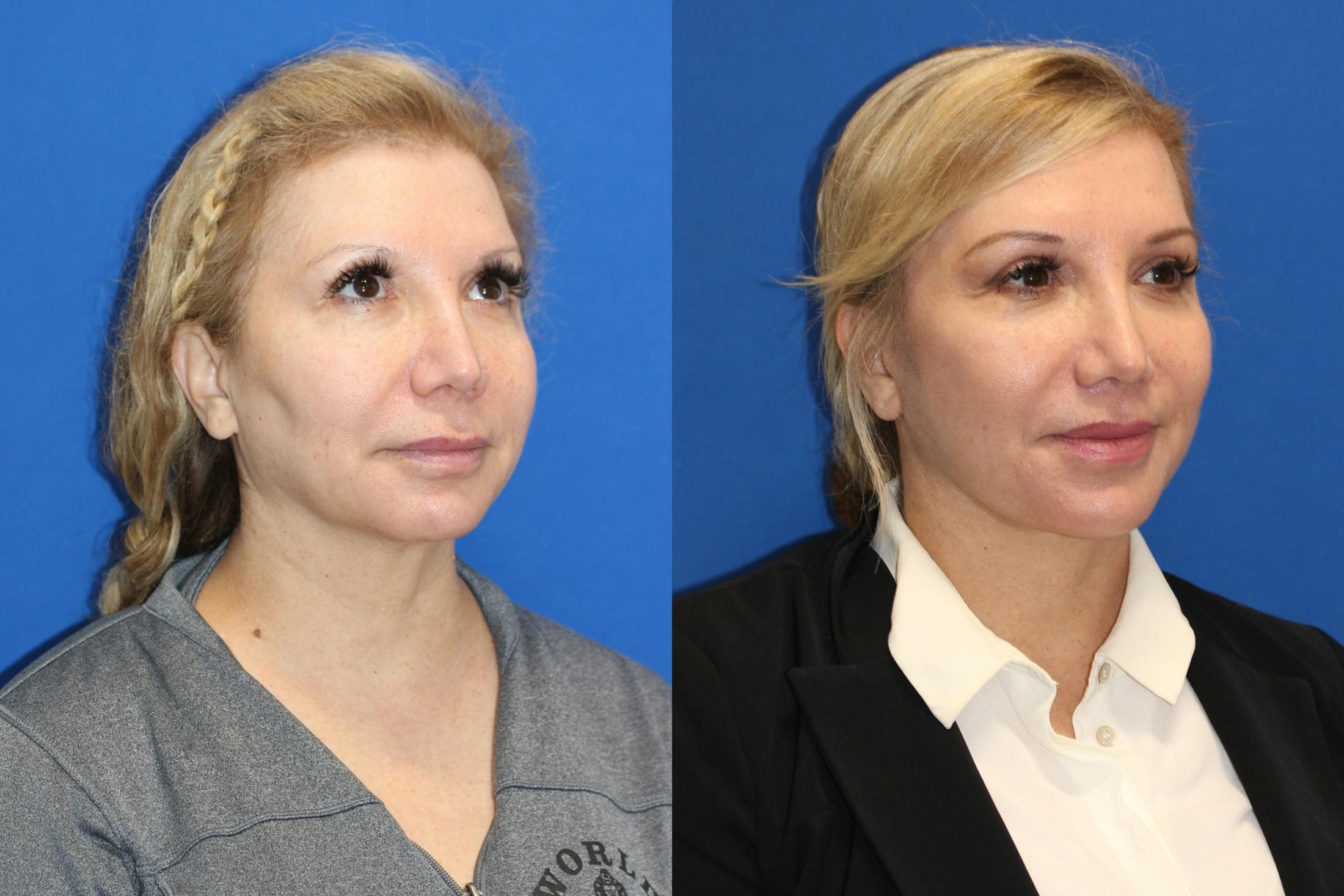 Vertical Restore® / Facial Rejuvenation Before & After Gallery - Patient 76142730 - Image 3