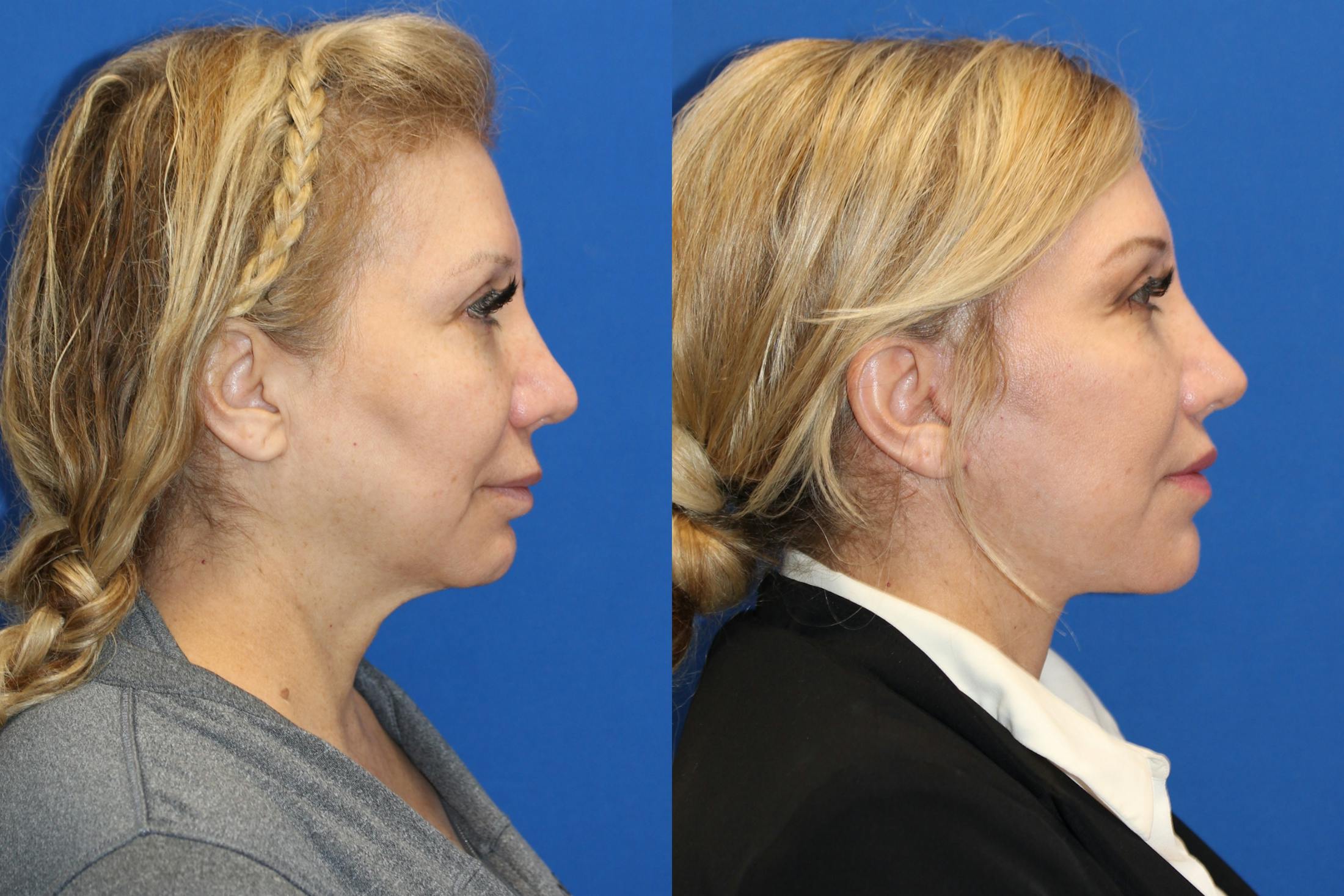 Vertical Restore® / Facial Rejuvenation Before & After Gallery - Patient 76142730 - Image 2