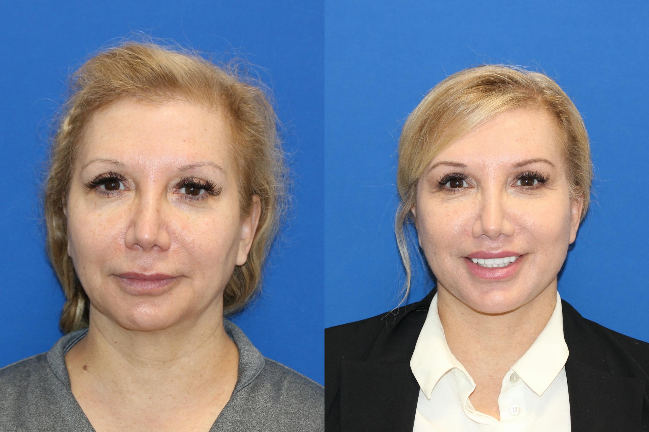 Vertical Restore® / Facial Rejuvenation Before & After Gallery - Patient 76142730 - Image 1