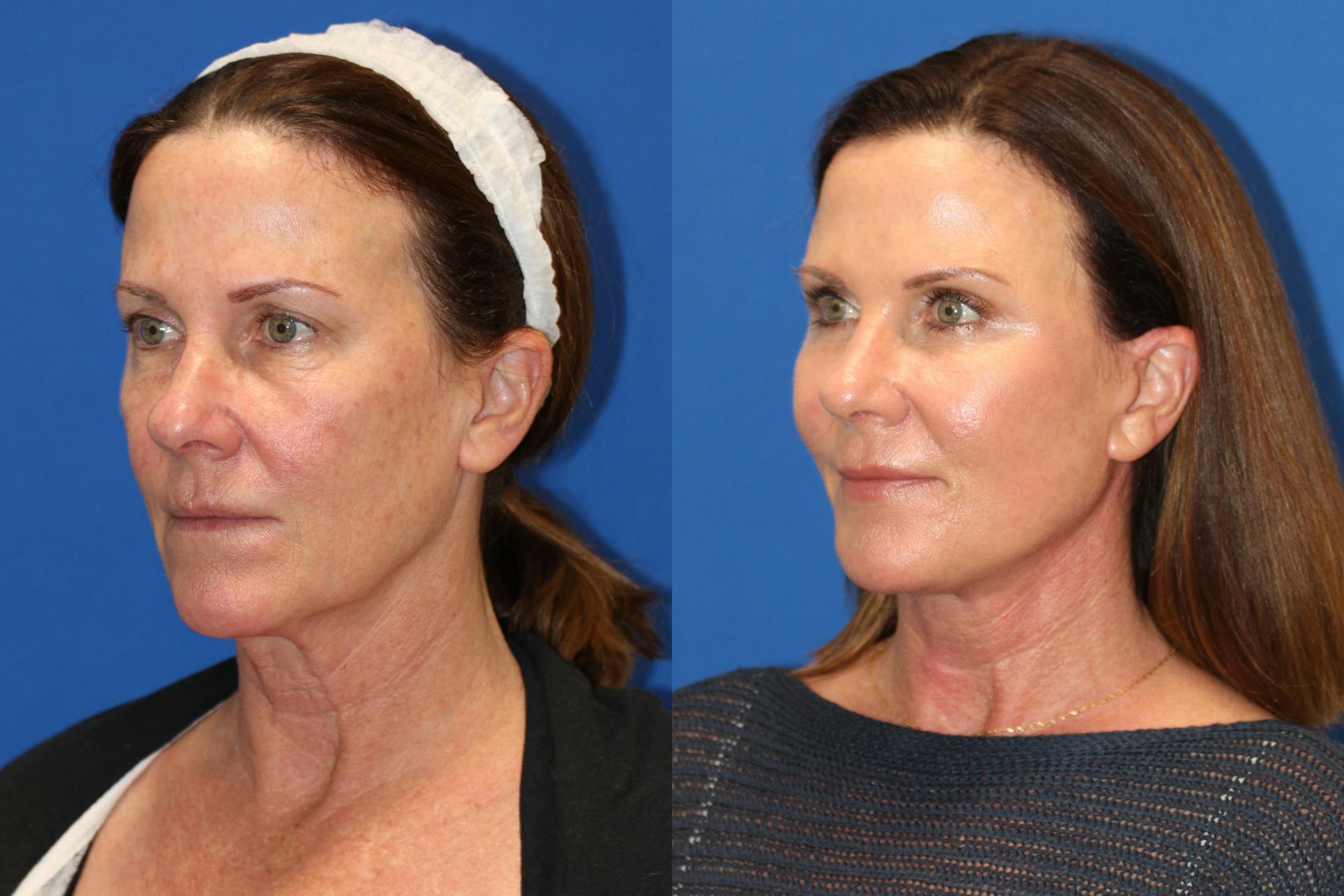 Vertical Restore® / Facial Rejuvenation Before & After Gallery - Patient 76142717 - Image 5