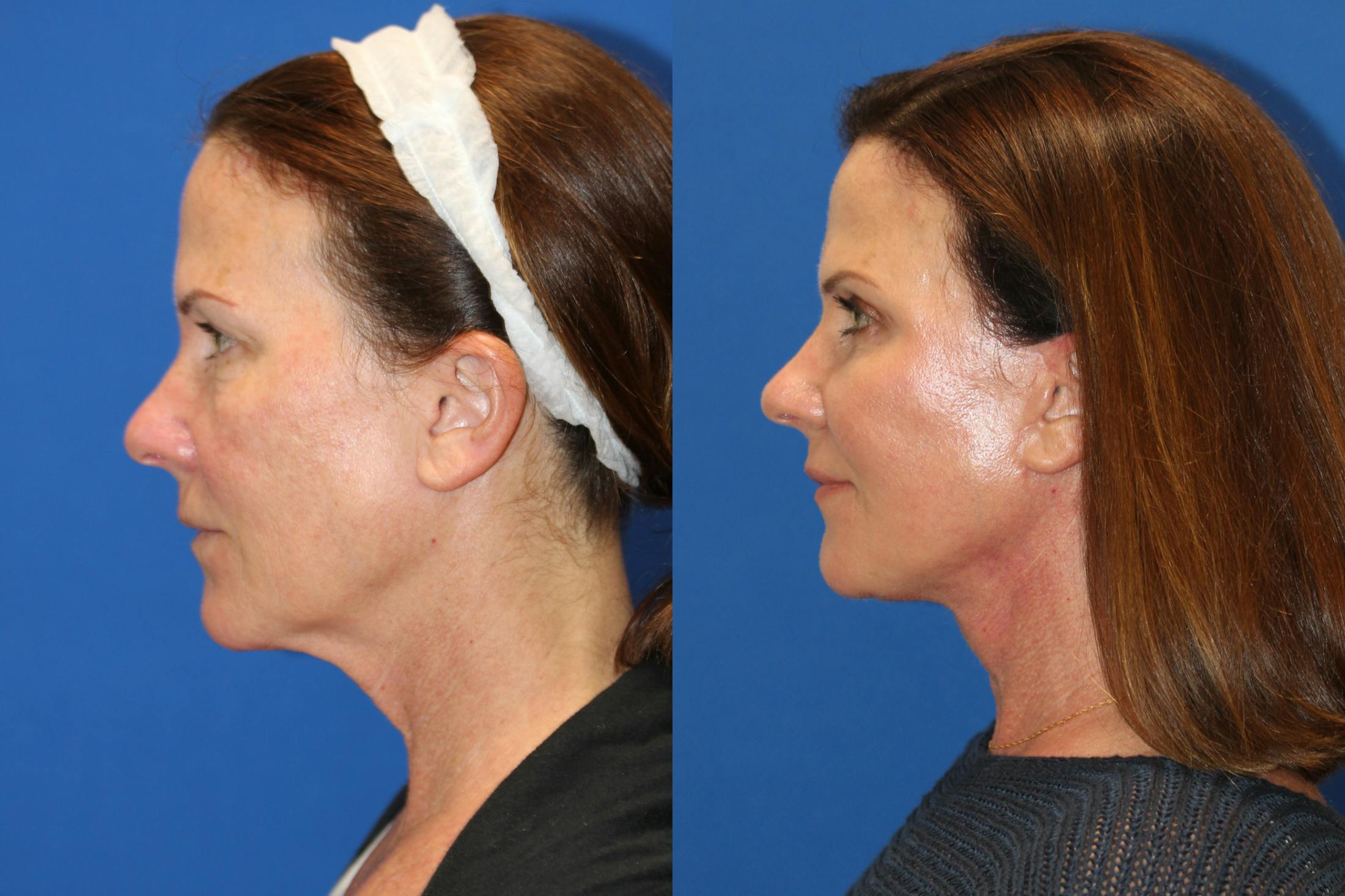 Vertical Restore® / Facial Rejuvenation Before & After Gallery - Patient 76142717 - Image 4