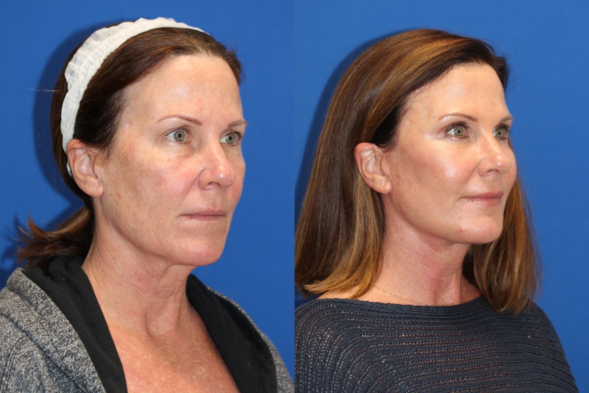 Neck Lift Before & After Gallery - Patient 85195745 - Image 2