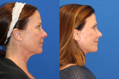 Neck Lift Before & After Gallery - Patient 85195745 - Image 1