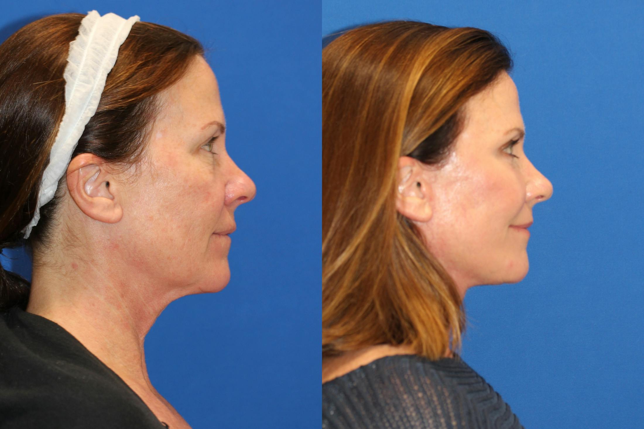Fat Transfer Before & After Gallery - Patient 87434297 - Image 2