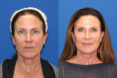 Vertical Restore® / Facial Rejuvenation Before & After Gallery - Patient 76142717 - Image 1