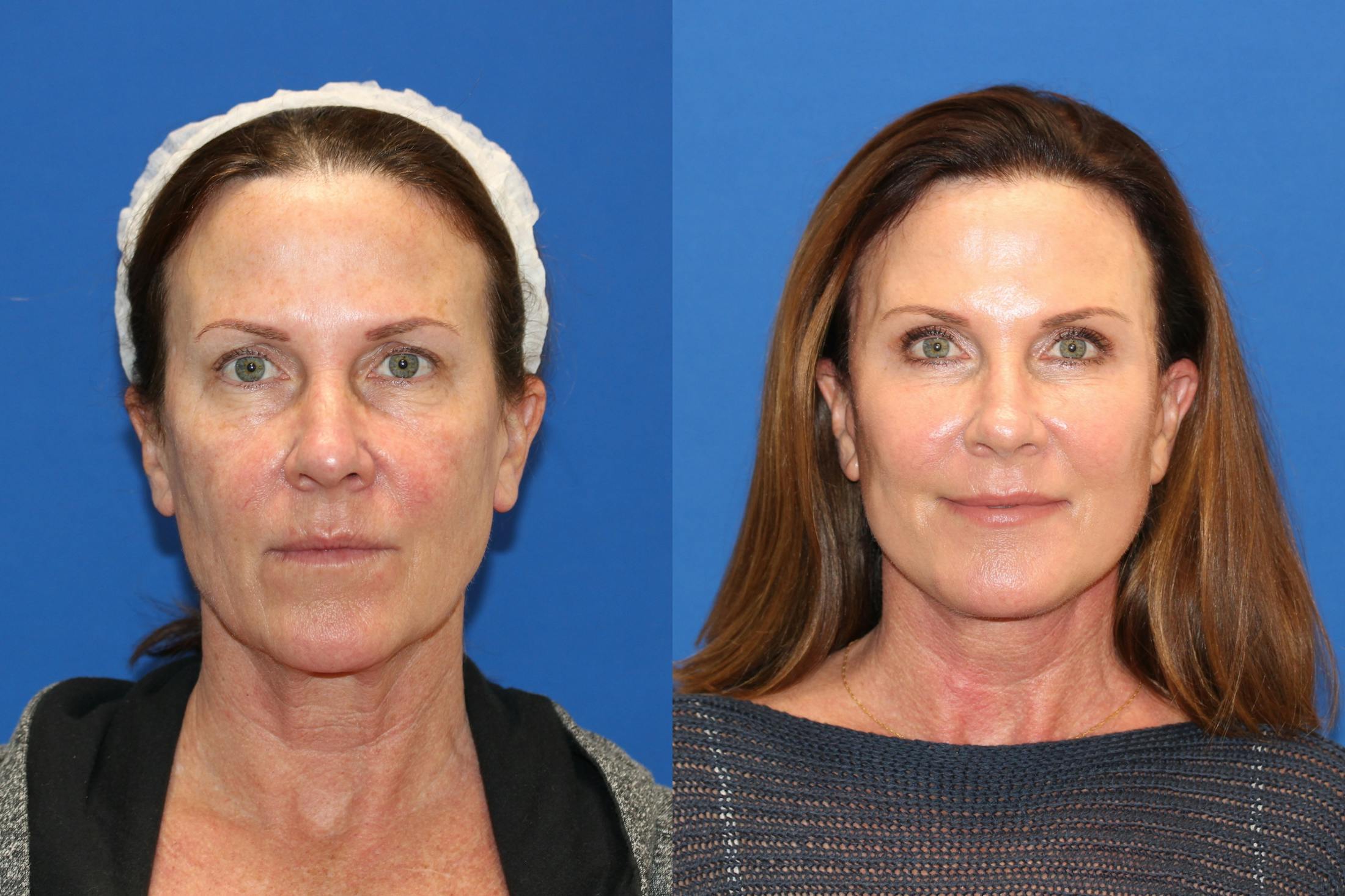 Vertical Restore® / Facial Rejuvenation Before & After Gallery - Patient 76142717 - Image 1