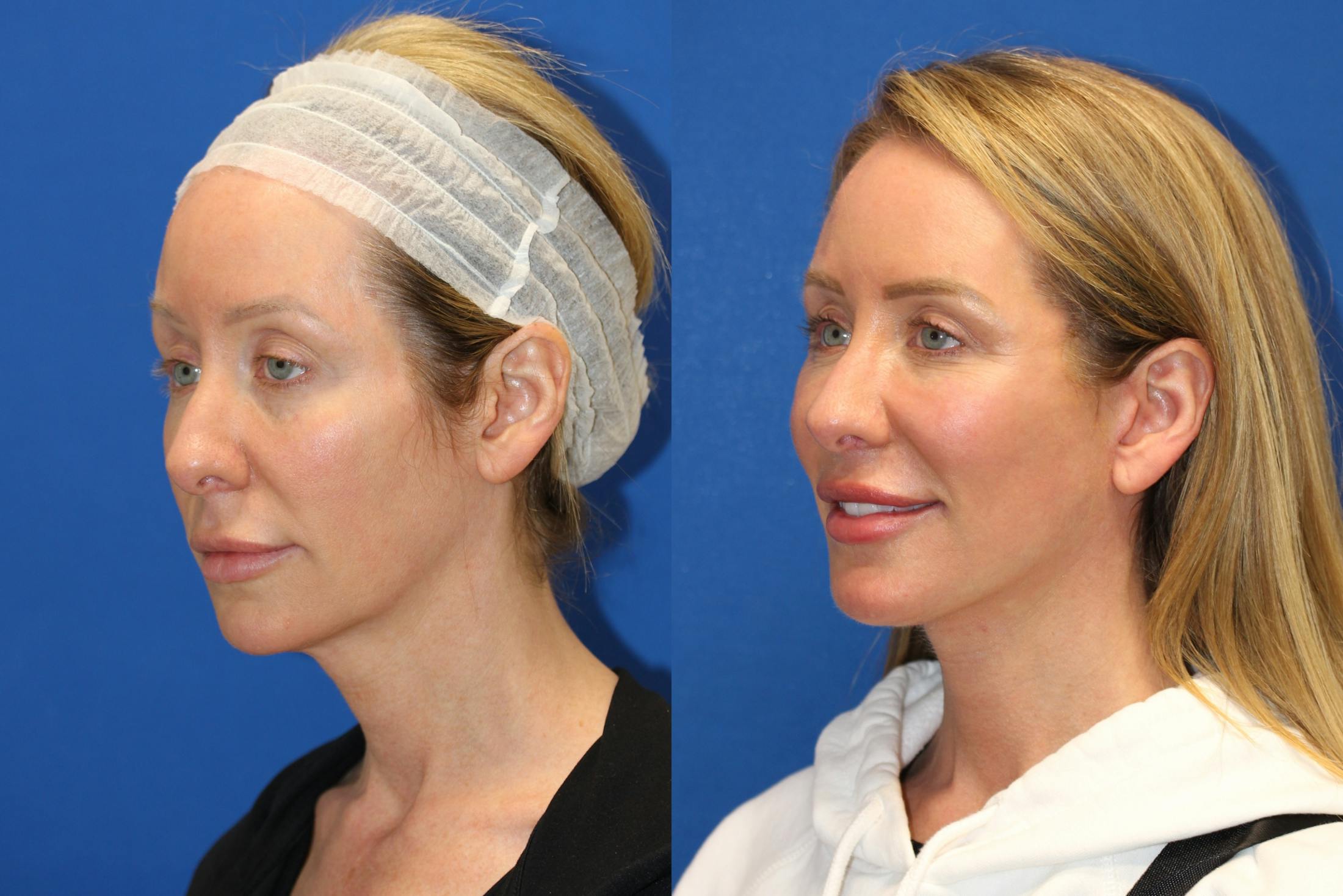 Vertical Restore® / Facial Rejuvenation Before & After Gallery - Patient 76129747 - Image 5