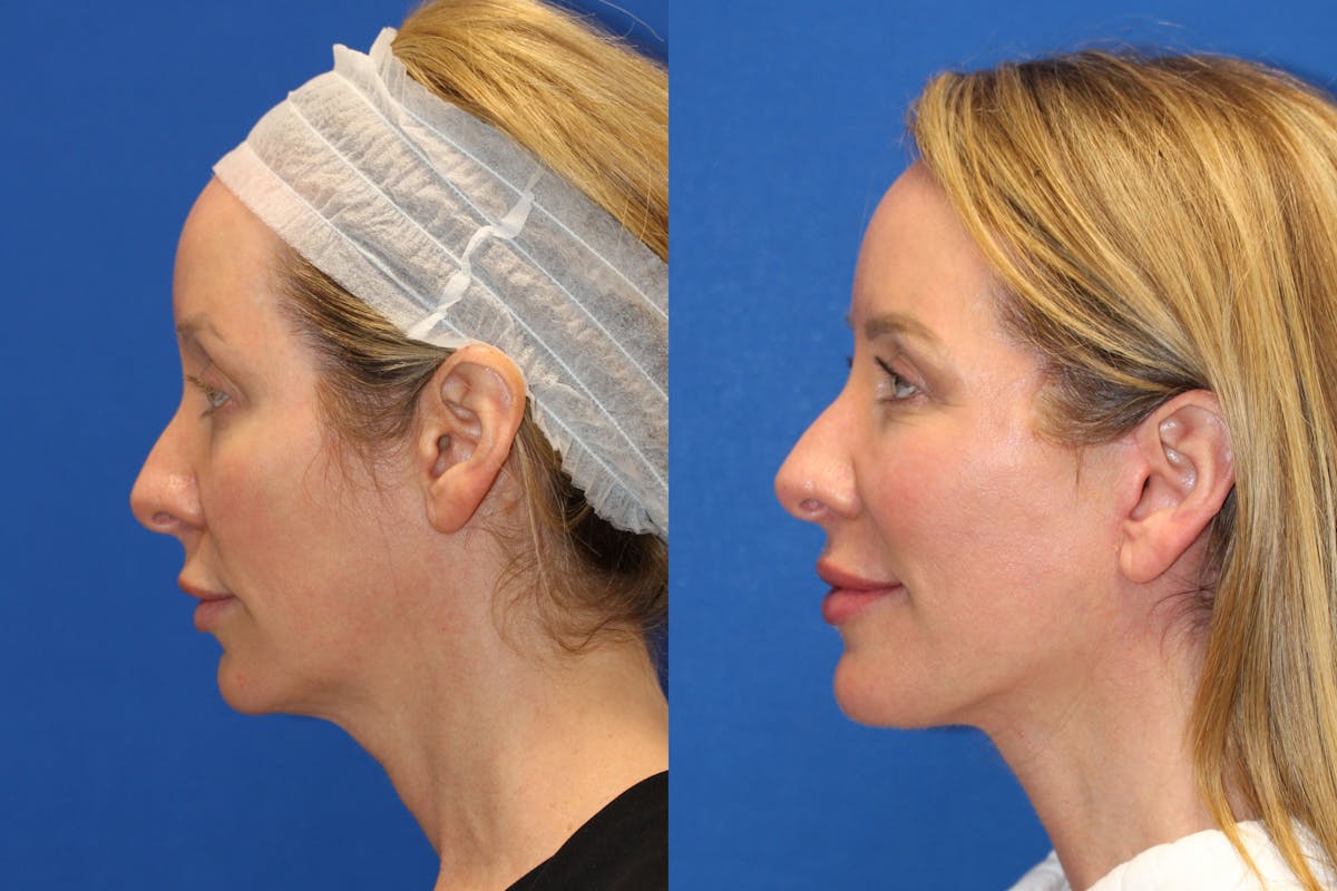 Vertical Restore® / Facial Rejuvenation Before & After Gallery - Patient 76129747 - Image 4