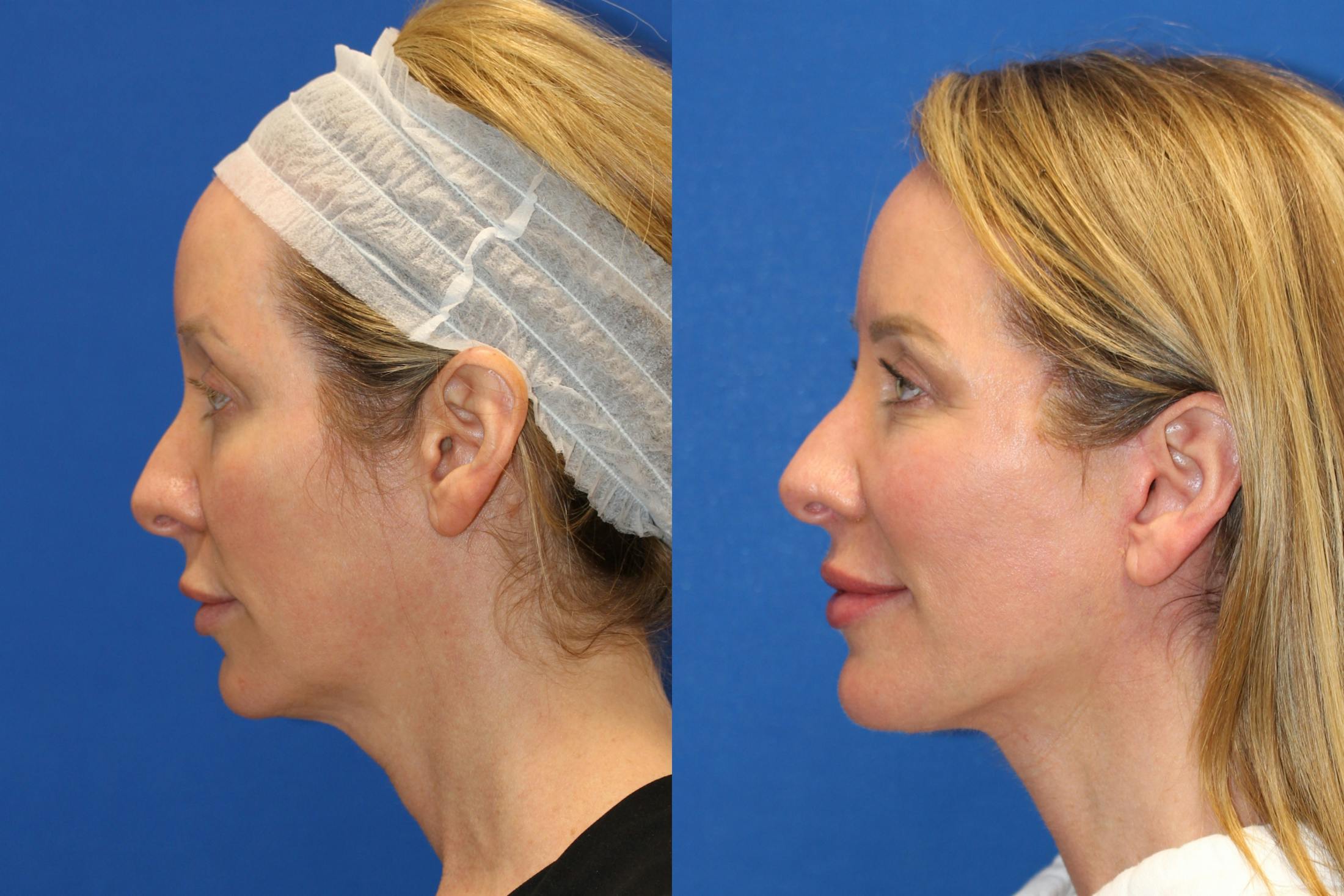 Vertical Restore® / Facial Rejuvenation Gallery - Patient 76129747 - Image 4