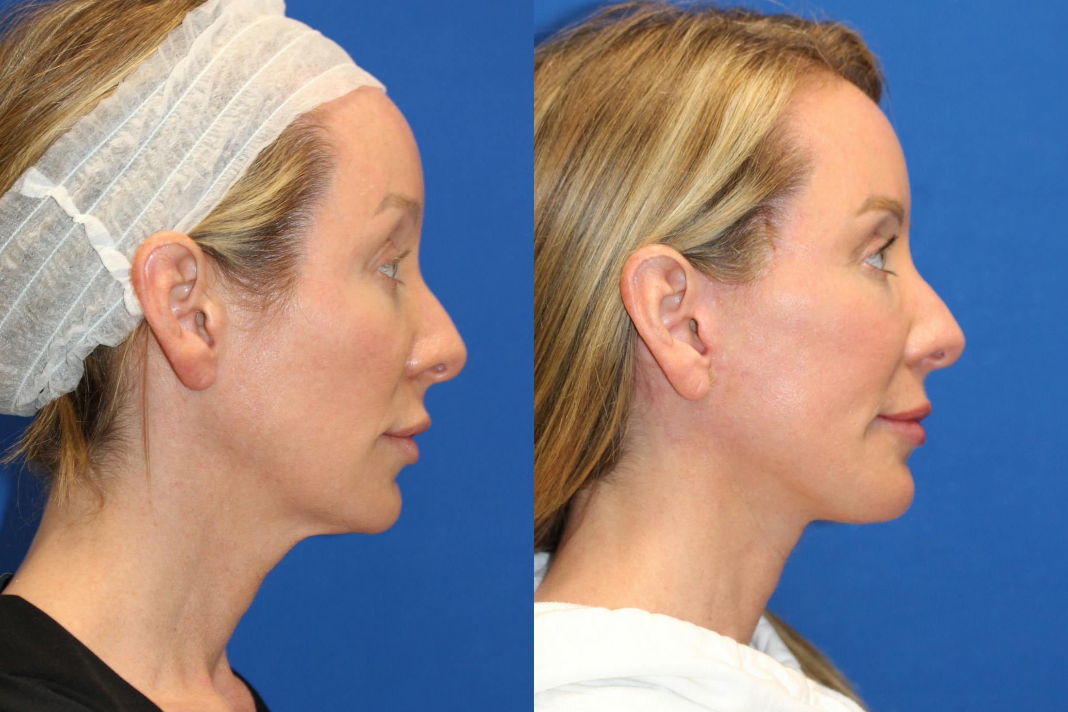 Fat Transfer Before & After Gallery - Patient 89265930 - Image 3