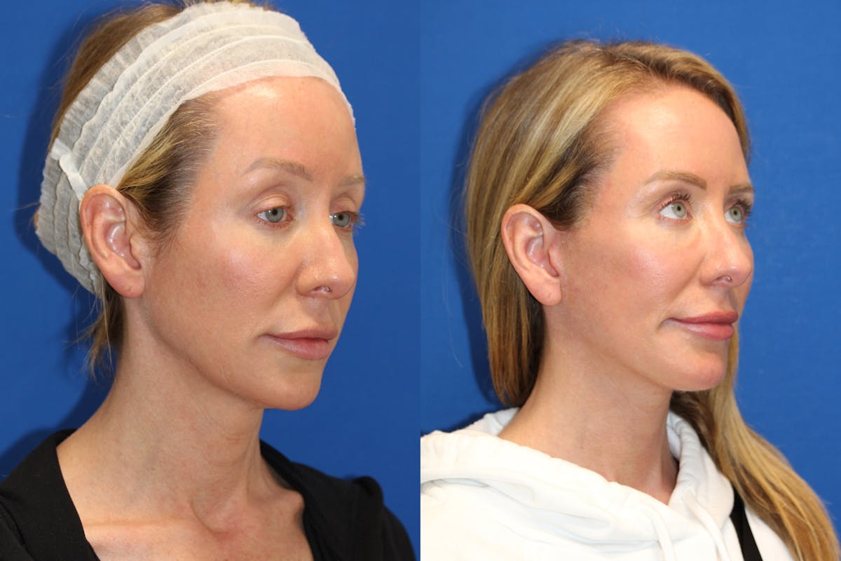 Vertical Restore® / Facial Rejuvenation Before & After Gallery - Patient 76129747 - Image 2