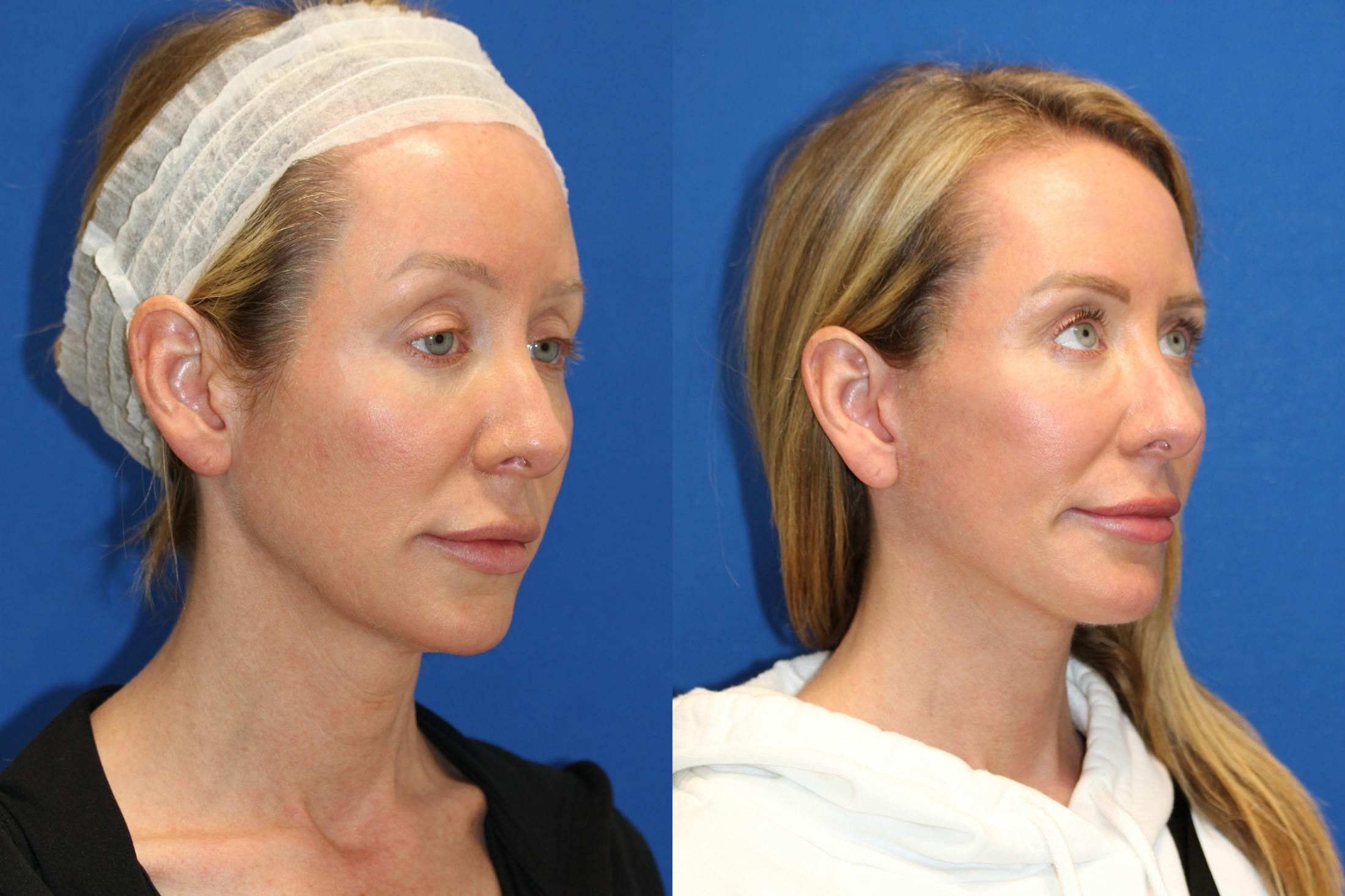 Vertical Restore® / Facial Rejuvenation Before & After Gallery - Patient 76129747 - Image 2